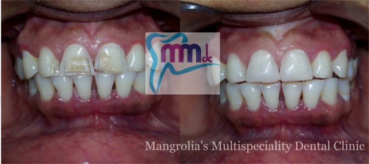 Before and after photographs of a tooth coloured composite restoration