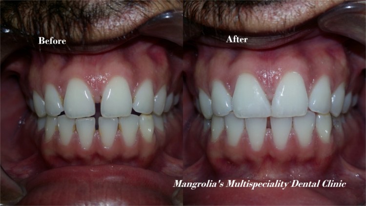 Before and after photographs of a gap between front teeth closed with composite