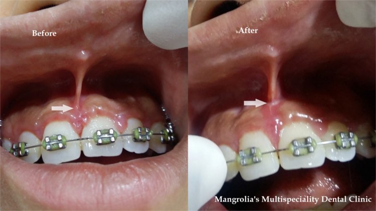 Before and after photographs of a frenectomy carried out with a laser
