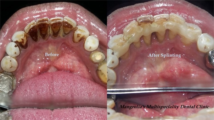 Before and after photographs of fibre splinting