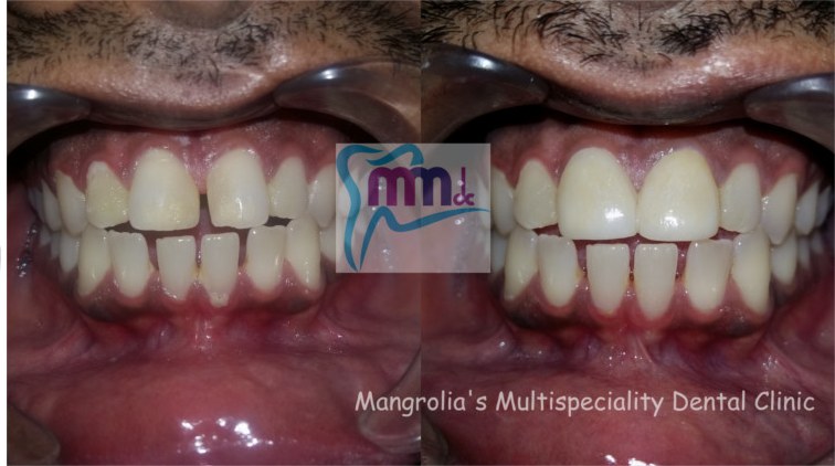 Before and after photographs of veneers and laminates