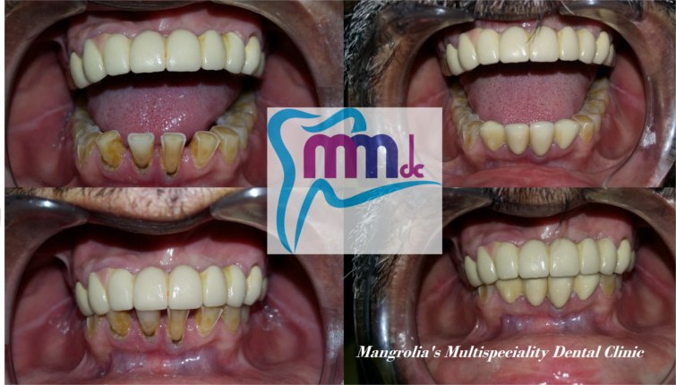 Before and after photographs of zirconia crowns